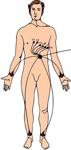 Schema eines menschlichen Körpers mit den EKG-Ableitungen V1 bis V6 auf dem Brustkorb und den Gliedmaßen für die Herzüberwachung